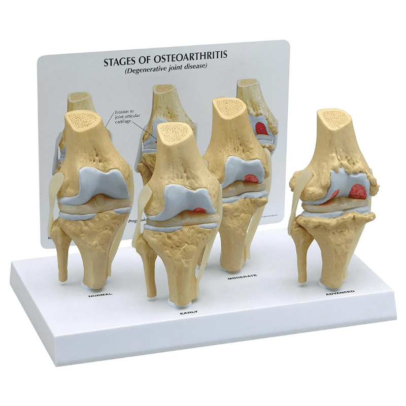4 Stage Osteoarthritis Knee Anatomical Model