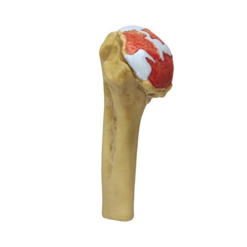 4 Stage Shoulder Osteoarthritis Anatomical Model | HMGDIRECT – HMGDirect