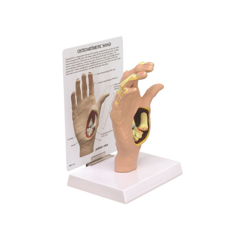 Hand Osteoarthritis Anatomical Model | HMGDIRECT Australia – HMGDirect