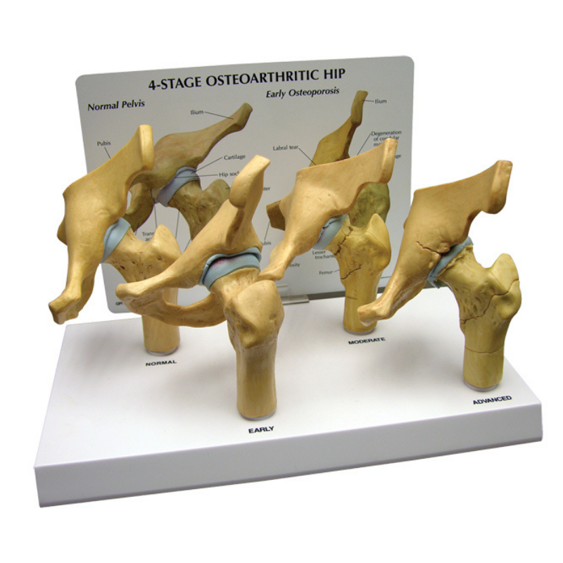4 Stage Hip Osteoarthritis Anatomical Model