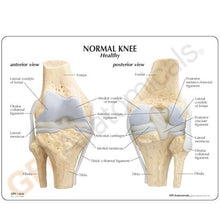 Load image into Gallery viewer, 4 Stage Osteoarthritis Knee Anatomical Model
