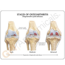 Load image into Gallery viewer, 4 Stage Osteoarthritis Knee Anatomical Model
