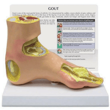 Load image into Gallery viewer, Foot Gout Anatomical Model
