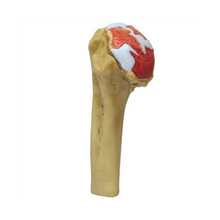 Load image into Gallery viewer, 4 Stage Shoulder Osteoarthritis Anatomical Model
