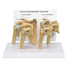 Load image into Gallery viewer, 4 Stage Shoulder Osteoarthritis Anatomical Model
