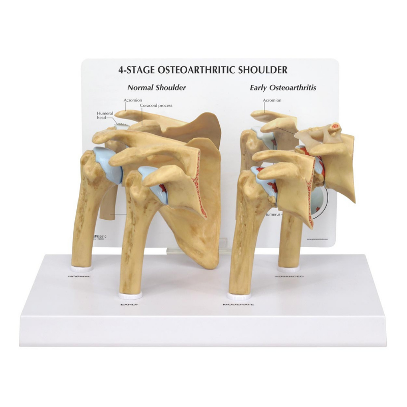 4 Stage Shoulder Osteoarthritis Anatomical Model