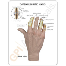 Load image into Gallery viewer, Hand Osteoarthritis Anatomical Model
