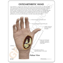 Load image into Gallery viewer, Hand Osteoarthritis Anatomical Model
