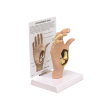 Load image into Gallery viewer, Hand Osteoarthritis Anatomical Model
