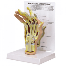 Load image into Gallery viewer, Hand Rheumatoid Arthritis Anatomical Model
