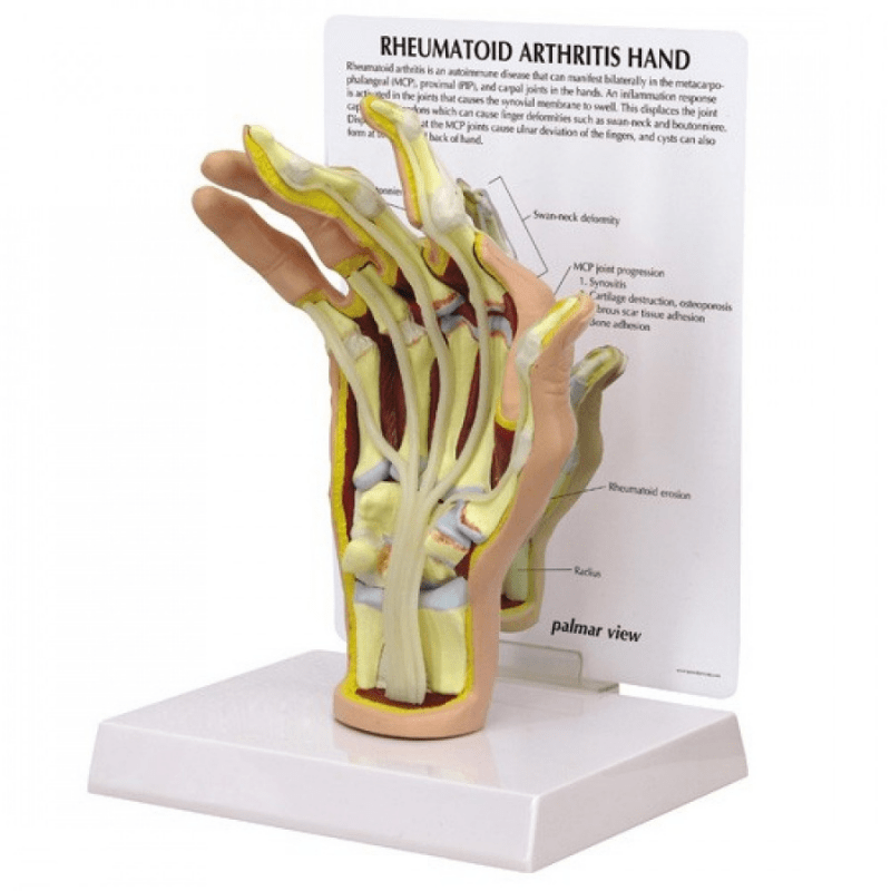 Hand Rheumatoid Arthritis Anatomical Model