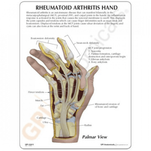 Load image into Gallery viewer, Hand Rheumatoid Arthritis Anatomical Model
