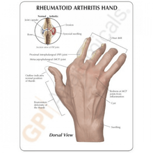 Load image into Gallery viewer, Hand Rheumatoid Arthritis Anatomical Model
