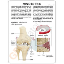 Load image into Gallery viewer, Knee Meniscus Tears Anatomical Model
