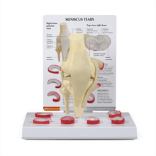 Load image into Gallery viewer, Knee Meniscus Tears Anatomical Model
