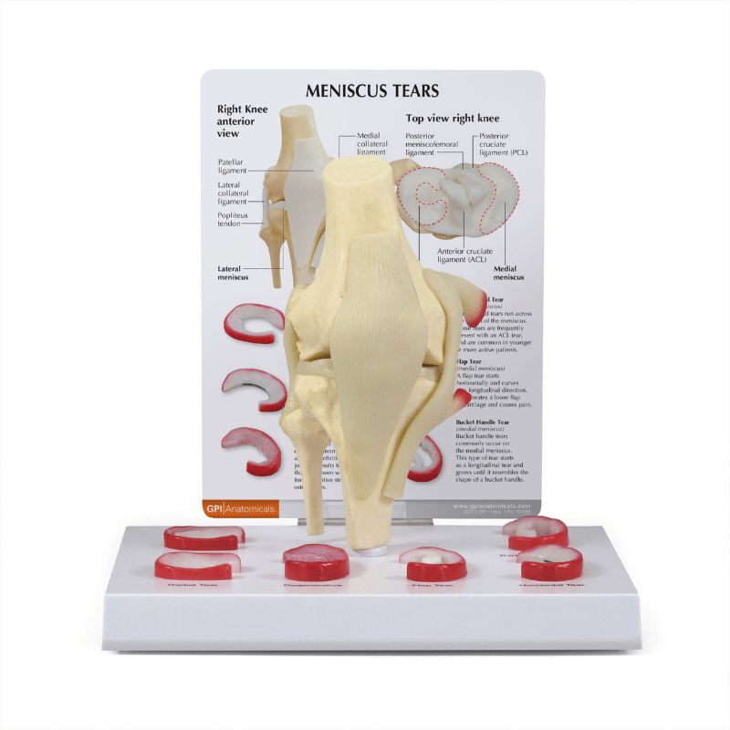 Knee Meniscus Tears Anatomical Model