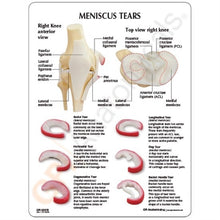 Load image into Gallery viewer, Knee Meniscus Tears Anatomical Model
